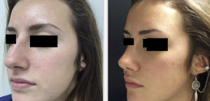 eyJpdCI6IlByaW1hIGUgRG9wbyBJbnRlcnZlbnRvIFJpbm9wbGFzdGljYSBhIE5hcG9saSIsImVuIjoiQmVmb3JlIGFuZCBBZnRlciBSaGlub3BsYXN0eSBTdXJnZXJ5IGluIE5hcGxlcyJ9