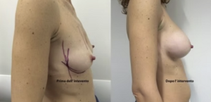 eyJpdCI6IlByaW1hIGUgRG9wbyBJbnRlcnZlbnRvIE1hc3RvcGxhc3RpY2EgQWRkaXRpdmEgYSBOYXBvbGkiLCJlbiI6IkJlZm9yZSBhbmQgQWZ0ZXIgQnJlYXN0IEF1Z21lbnRhdGlvbiBTdXJnZXJ5IGluIE5hcGxlcyJ9 eyJpdCI6IlByaW1hIGUgRG9wbyBJbnRlcnZlbnRvIE1hc3RvcGxhc3RpY2EgQWRkaXRpdmEgYSBOYXBvbGkiLCJlbiI6IkJlZm9yZSBhbmQgQWZ0ZXIgQnJlYXN0IEF1Z21lbnRhdGlvbiBTdXJnZXJ5IGluIE5hcGxlcyJ9