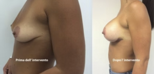 eyJpdCI6IlByaW1hIGUgRG9wbyBJbnRlcnZlbnRvIE1hc3RvcGxhc3RpY2EgQWRkaXRpdmEgYSBOYXBvbGkiLCJlbiI6IkJlZm9yZSBhbmQgQWZ0ZXIgQnJlYXN0IEF1Z21lbnRhdGlvbiBTdXJnZXJ5IGluIE5hcGxlcyJ9 eyJpdCI6IlByaW1hIGUgRG9wbyBJbnRlcnZlbnRvIE1hc3RvcGxhc3RpY2EgQWRkaXRpdmEgYSBOYXBvbGkiLCJlbiI6IkJlZm9yZSBhbmQgQWZ0ZXIgQnJlYXN0IEF1Z21lbnRhdGlvbiBTdXJnZXJ5IGluIE5hcGxlcyJ9