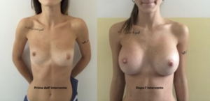 eyJpdCI6IlByaW1hIGUgRG9wbyBJbnRlcnZlbnRvIE1hc3RvcGxhc3RpY2EgQWRkaXRpdmEgYSBOYXBvbGkiLCJlbiI6IkJlZm9yZSBhbmQgQWZ0ZXIgQnJlYXN0IEF1Z21lbnRhdGlvbiBTdXJnZXJ5IGluIE5hcGxlcyJ9 eyJpdCI6IlByaW1hIGUgRG9wbyBJbnRlcnZlbnRvIE1hc3RvcGxhc3RpY2EgQWRkaXRpdmEgYSBOYXBvbGkiLCJlbiI6IkJlZm9yZSBhbmQgQWZ0ZXIgQnJlYXN0IEF1Z21lbnRhdGlvbiBTdXJnZXJ5IGluIE5hcGxlcyJ9