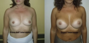 eyJpdCI6IlByaW1hIGUgRG9wbyBJbnRlcnZlbnRvIE1hc3RvcGxhc3RpY2EgQWRkaXRpdmEgYSBOYXBvbGkiLCJlbiI6IkJlZm9yZSBhbmQgQWZ0ZXIgQnJlYXN0IEF1Z21lbnRhdGlvbiBTdXJnZXJ5IGluIE5hcGxlcyJ9 eyJpdCI6IlByaW1hIGUgRG9wbyBJbnRlcnZlbnRvIE1hc3RvcGxhc3RpY2EgQWRkaXRpdmEgYSBOYXBvbGkiLCJlbiI6IkJlZm9yZSBhbmQgQWZ0ZXIgQnJlYXN0IEF1Z21lbnRhdGlvbiBTdXJnZXJ5IGluIE5hcGxlcyJ9