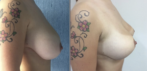 Prima e Dopo Intervento Mastoplastica Riduttiva a Napoli