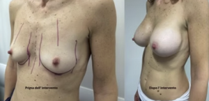 eyJpdCI6IlByaW1hIGUgRG9wbyBJbnRlcnZlbnRvIE1hc3RvcGxhc3RpY2EgQWRkaXRpdmEgYSBOYXBvbGkiLCJlbiI6IkJlZm9yZSBhbmQgQWZ0ZXIgQnJlYXN0IEF1Z21lbnRhdGlvbiBTdXJnZXJ5IGluIE5hcGxlcyJ9 eyJpdCI6IlByaW1hIGUgRG9wbyBJbnRlcnZlbnRvIE1hc3RvcGxhc3RpY2EgQWRkaXRpdmEgYSBOYXBvbGkiLCJlbiI6IkJlZm9yZSBhbmQgQWZ0ZXIgQnJlYXN0IEF1Z21lbnRhdGlvbiBTdXJnZXJ5IGluIE5hcGxlcyJ9