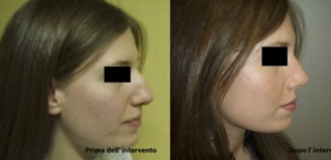 eyJpdCI6IlByaW1hIGUgRG9wbyBJbnRlcnZlbnRvIFJpbm9wbGFzdGljYSBhIE5hcG9saSIsImVuIjoiQmVmb3JlIGFuZCBBZnRlciBSaGlub3BsYXN0eSBTdXJnZXJ5IGluIE5hcGxlcyJ9