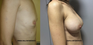 eyJpdCI6IlByaW1hIGUgRG9wbyBJbnRlcnZlbnRvIE1hc3RvcGxhc3RpY2EgQWRkaXRpdmEgYSBOYXBvbGkiLCJlbiI6IkJlZm9yZSBhbmQgQWZ0ZXIgQnJlYXN0IEF1Z21lbnRhdGlvbiBTdXJnZXJ5IGluIE5hcGxlcyJ9 eyJpdCI6IlByaW1hIGUgRG9wbyBJbnRlcnZlbnRvIE1hc3RvcGxhc3RpY2EgQWRkaXRpdmEgYSBOYXBvbGkiLCJlbiI6IkJlZm9yZSBhbmQgQWZ0ZXIgQnJlYXN0IEF1Z21lbnRhdGlvbiBTdXJnZXJ5IGluIE5hcGxlcyJ9