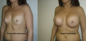 eyJpdCI6IlByaW1hIGUgRG9wbyBJbnRlcnZlbnRvIE1hc3RvcGxhc3RpY2EgQWRkaXRpdmEgYSBOYXBvbGkiLCJlbiI6IkJlZm9yZSBhbmQgQWZ0ZXIgQnJlYXN0IEF1Z21lbnRhdGlvbiBTdXJnZXJ5IGluIE5hcGxlcyJ9 eyJpdCI6IlByaW1hIGUgRG9wbyBJbnRlcnZlbnRvIE1hc3RvcGxhc3RpY2EgQWRkaXRpdmEgYSBOYXBvbGkiLCJlbiI6IkJlZm9yZSBhbmQgQWZ0ZXIgQnJlYXN0IEF1Z21lbnRhdGlvbiBTdXJnZXJ5IGluIE5hcGxlcyJ9