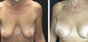 Prima e Dopo Intervento Mastoplastica Riduttiva a Napoli