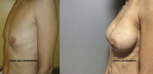 eyJpdCI6IlByaW1hIGUgRG9wbyBJbnRlcnZlbnRvIE1hc3RvcGxhc3RpY2EgQWRkaXRpdmEgYSBOYXBvbGkiLCJlbiI6IkJlZm9yZSBhbmQgQWZ0ZXIgQnJlYXN0IEF1Z21lbnRhdGlvbiBTdXJnZXJ5IGluIE5hcGxlcyJ9 eyJpdCI6IlByaW1hIGUgRG9wbyBJbnRlcnZlbnRvIE1hc3RvcGxhc3RpY2EgQWRkaXRpdmEgYSBOYXBvbGkiLCJlbiI6IkJlZm9yZSBhbmQgQWZ0ZXIgQnJlYXN0IEF1Z21lbnRhdGlvbiBTdXJnZXJ5IGluIE5hcGxlcyJ9