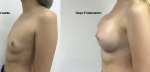 eyJpdCI6IlByaW1hIGUgRG9wbyBJbnRlcnZlbnRvIE1hc3RvcGxhc3RpY2EgQWRkaXRpdmEgYSBOYXBvbGkiLCJlbiI6IkJlZm9yZSBhbmQgQWZ0ZXIgQnJlYXN0IEF1Z21lbnRhdGlvbiBTdXJnZXJ5IGluIE5hcGxlcyJ9 eyJpdCI6IlByaW1hIGUgRG9wbyBJbnRlcnZlbnRvIE1hc3RvcGxhc3RpY2EgQWRkaXRpdmEgYSBOYXBvbGkiLCJlbiI6IkJlZm9yZSBhbmQgQWZ0ZXIgQnJlYXN0IEF1Z21lbnRhdGlvbiBTdXJnZXJ5IGluIE5hcGxlcyJ9