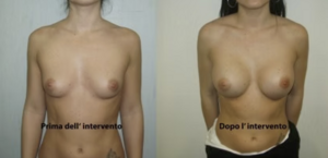 eyJpdCI6IlByaW1hIGUgRG9wbyBJbnRlcnZlbnRvIE1hc3RvcGxhc3RpY2EgQWRkaXRpdmEgYSBOYXBvbGkiLCJlbiI6IkJlZm9yZSBhbmQgQWZ0ZXIgQnJlYXN0IEF1Z21lbnRhdGlvbiBTdXJnZXJ5IGluIE5hcGxlcyJ9 eyJpdCI6IlByaW1hIGUgRG9wbyBJbnRlcnZlbnRvIE1hc3RvcGxhc3RpY2EgQWRkaXRpdmEgYSBOYXBvbGkiLCJlbiI6IkJlZm9yZSBhbmQgQWZ0ZXIgQnJlYXN0IEF1Z21lbnRhdGlvbiBTdXJnZXJ5IGluIE5hcGxlcyJ9