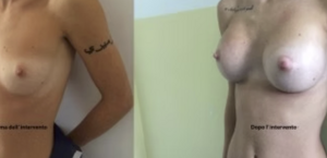 eyJpdCI6IlByaW1hIGUgRG9wbyBJbnRlcnZlbnRvIE1hc3RvcGxhc3RpY2EgQWRkaXRpdmEgYSBOYXBvbGkiLCJlbiI6IkJlZm9yZSBhbmQgQWZ0ZXIgQnJlYXN0IEF1Z21lbnRhdGlvbiBTdXJnZXJ5IGluIE5hcGxlcyJ9 eyJpdCI6IlByaW1hIGUgRG9wbyBJbnRlcnZlbnRvIE1hc3RvcGxhc3RpY2EgQWRkaXRpdmEgYSBOYXBvbGkiLCJlbiI6IkJlZm9yZSBhbmQgQWZ0ZXIgQnJlYXN0IEF1Z21lbnRhdGlvbiBTdXJnZXJ5IGluIE5hcGxlcyJ9