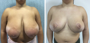 Prima e Dopo Intervento Mastoplastica Riduttiva a Napoli