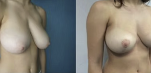 eyJpdCI6IlByaW1hIGUgRG9wbyBJbnRlcnZlbnRvIE1hc3RvcGxhc3RpY2EgQWRkaXRpdmEgYSBOYXBvbGkiLCJlbiI6IkJlZm9yZSBhbmQgQWZ0ZXIgQnJlYXN0IEF1Z21lbnRhdGlvbiBTdXJnZXJ5IGluIE5hcGxlcyJ9 eyJpdCI6IlByaW1hIGUgRG9wbyBJbnRlcnZlbnRvIE1hc3RvcGxhc3RpY2EgQWRkaXRpdmEgYSBOYXBvbGkiLCJlbiI6IkJlZm9yZSBhbmQgQWZ0ZXIgQnJlYXN0IEF1Z21lbnRhdGlvbiBTdXJnZXJ5IGluIE5hcGxlcyJ9