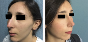 eyJpdCI6IlByaW1hIGUgRG9wbyBJbnRlcnZlbnRvIFJpbm9wbGFzdGljYSBhIE5hcG9saSIsImVuIjoiQmVmb3JlIGFuZCBBZnRlciBSaGlub3BsYXN0eSBTdXJnZXJ5IGluIE5hcGxlcyJ9