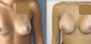 eyJpdCI6IlByaW1hIGUgRG9wbyBJbnRlcnZlbnRvIE1hc3RvcGxhc3RpY2EgQWRkaXRpdmEgYSBOYXBvbGkiLCJlbiI6IkJlZm9yZSBhbmQgQWZ0ZXIgQnJlYXN0IEF1Z21lbnRhdGlvbiBTdXJnZXJ5IGluIE5hcGxlcyJ9 eyJpdCI6IlByaW1hIGUgRG9wbyBJbnRlcnZlbnRvIE1hc3RvcGxhc3RpY2EgQWRkaXRpdmEgYSBOYXBvbGkiLCJlbiI6IkJlZm9yZSBhbmQgQWZ0ZXIgQnJlYXN0IEF1Z21lbnRhdGlvbiBTdXJnZXJ5IGluIE5hcGxlcyJ9