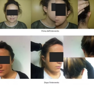 Prima e Dopo Intervento Otoplastica Napoli 