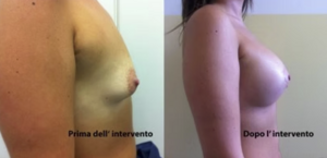 eyJpdCI6IlByaW1hIGUgRG9wbyBJbnRlcnZlbnRvIE1hc3RvcGxhc3RpY2EgQWRkaXRpdmEgYSBOYXBvbGkiLCJlbiI6IkJlZm9yZSBhbmQgQWZ0ZXIgQnJlYXN0IEF1Z21lbnRhdGlvbiBTdXJnZXJ5IGluIE5hcGxlcyJ9 eyJpdCI6IlByaW1hIGUgRG9wbyBJbnRlcnZlbnRvIE1hc3RvcGxhc3RpY2EgQWRkaXRpdmEgYSBOYXBvbGkiLCJlbiI6IkJlZm9yZSBhbmQgQWZ0ZXIgQnJlYXN0IEF1Z21lbnRhdGlvbiBTdXJnZXJ5IGluIE5hcGxlcyJ9