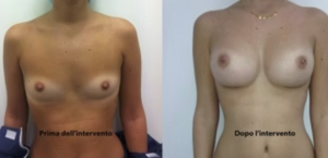 eyJpdCI6IlByaW1hIGUgRG9wbyBJbnRlcnZlbnRvIE1hc3RvcGxhc3RpY2EgQWRkaXRpdmEgYSBOYXBvbGkiLCJlbiI6IkJlZm9yZSBhbmQgQWZ0ZXIgQnJlYXN0IEF1Z21lbnRhdGlvbiBTdXJnZXJ5IGluIE5hcGxlcyJ9 eyJpdCI6IlByaW1hIGUgRG9wbyBJbnRlcnZlbnRvIE1hc3RvcGxhc3RpY2EgQWRkaXRpdmEgYSBOYXBvbGkiLCJlbiI6IkJlZm9yZSBhbmQgQWZ0ZXIgQnJlYXN0IEF1Z21lbnRhdGlvbiBTdXJnZXJ5IGluIE5hcGxlcyJ9