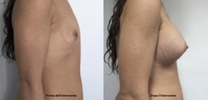 eyJpdCI6IlByaW1hIGUgRG9wbyBJbnRlcnZlbnRvIE1hc3RvcGxhc3RpY2EgQWRkaXRpdmEgYSBOYXBvbGkiLCJlbiI6IkJlZm9yZSBhbmQgQWZ0ZXIgQnJlYXN0IEF1Z21lbnRhdGlvbiBTdXJnZXJ5IGluIE5hcGxlcyJ9 eyJpdCI6IlByaW1hIGUgRG9wbyBJbnRlcnZlbnRvIE1hc3RvcGxhc3RpY2EgQWRkaXRpdmEgYSBOYXBvbGkiLCJlbiI6IkJlZm9yZSBhbmQgQWZ0ZXIgQnJlYXN0IEF1Z21lbnRhdGlvbiBTdXJnZXJ5IGluIE5hcGxlcyJ9