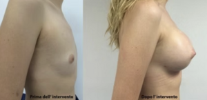 eyJpdCI6IlByaW1hIGUgRG9wbyBJbnRlcnZlbnRvIE1hc3RvcGxhc3RpY2EgQWRkaXRpdmEgYSBOYXBvbGkiLCJlbiI6IkJlZm9yZSBhbmQgQWZ0ZXIgQnJlYXN0IEF1Z21lbnRhdGlvbiBTdXJnZXJ5IGluIE5hcGxlcyJ9 eyJpdCI6IlByaW1hIGUgRG9wbyBJbnRlcnZlbnRvIE1hc3RvcGxhc3RpY2EgQWRkaXRpdmEgYSBOYXBvbGkiLCJlbiI6IkJlZm9yZSBhbmQgQWZ0ZXIgQnJlYXN0IEF1Z21lbnRhdGlvbiBTdXJnZXJ5IGluIE5hcGxlcyJ9