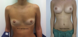 eyJpdCI6IlByaW1hIGUgRG9wbyBJbnRlcnZlbnRvIE1hc3RvcGxhc3RpY2EgQWRkaXRpdmEgYSBOYXBvbGkiLCJlbiI6IkJlZm9yZSBhbmQgQWZ0ZXIgQnJlYXN0IEF1Z21lbnRhdGlvbiBTdXJnZXJ5IGluIE5hcGxlcyJ9 eyJpdCI6IlByaW1hIGUgRG9wbyBJbnRlcnZlbnRvIE1hc3RvcGxhc3RpY2EgQWRkaXRpdmEgYSBOYXBvbGkiLCJlbiI6IkJlZm9yZSBhbmQgQWZ0ZXIgQnJlYXN0IEF1Z21lbnRhdGlvbiBTdXJnZXJ5IGluIE5hcGxlcyJ9