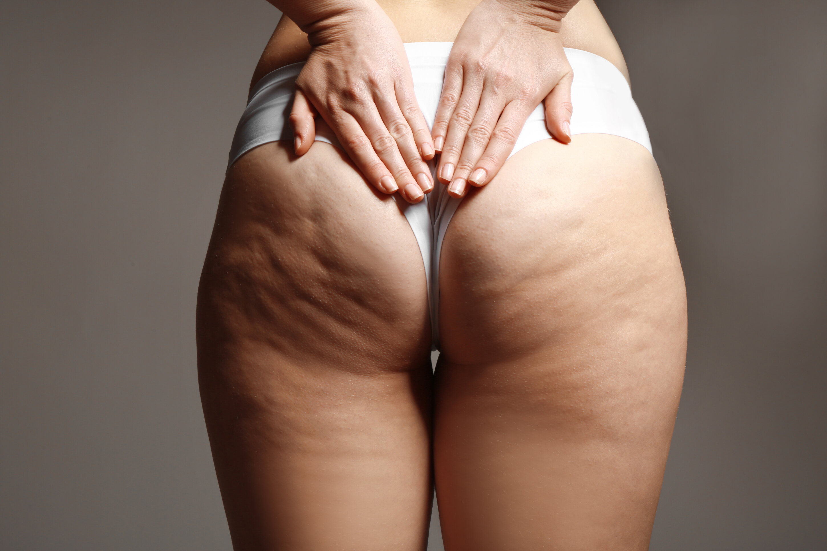 4 Stadi della Cellulite