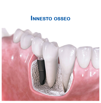 Chirurgia Implantologica - La Mutua - Foto 8