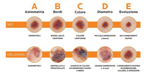 occhio-al-neo-prevenzione-del-melanoma