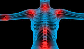 Guselkumab in artrite psoriasica: nuove prospettive per la cura della malattia