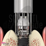r-brush-dispositivo-titanio-per-rimozione-biofilm-perimplantite
