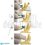 kit-screw-extractor-for-removal-of-fractured-screws-dental-implant