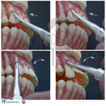 apexo-dental-luxator-for-atraumatic-tooth-extraction