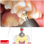 occlushape-dia-986-diamond-dental-burs-for-occlusal-shaping