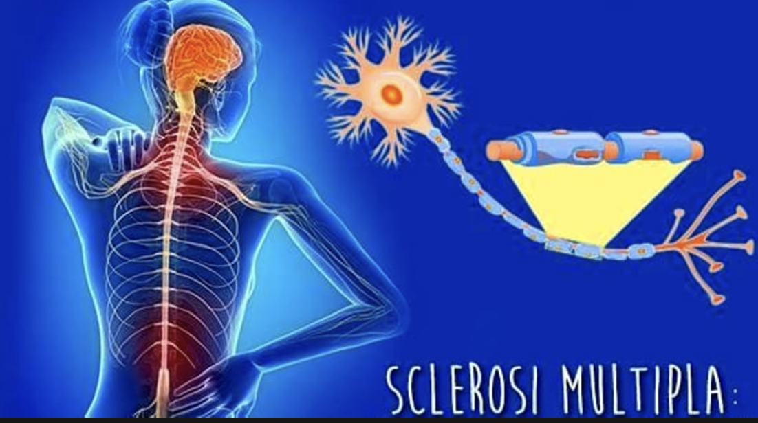 Sclerosi multipla, verso una medicina sempre più personalizzata