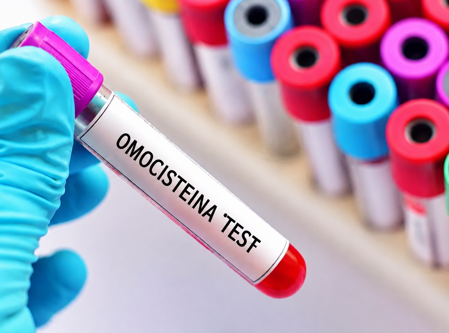 Omocisteina, il filo rosso tra metabolismo, genetica e medicina di genere