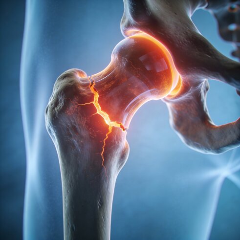 Frattura del femore Frattura del femore