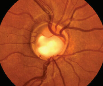 PREVENIRE E CURARE IL GLAUCOMA PREVENIRE E CURARE IL GLAUCOMA