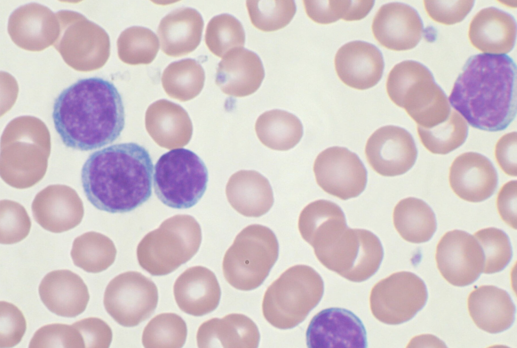 Su SudSalute Leucemia linfatica cronica: in Sicilia 200 nuove diagnosi l&rsquo;anno.