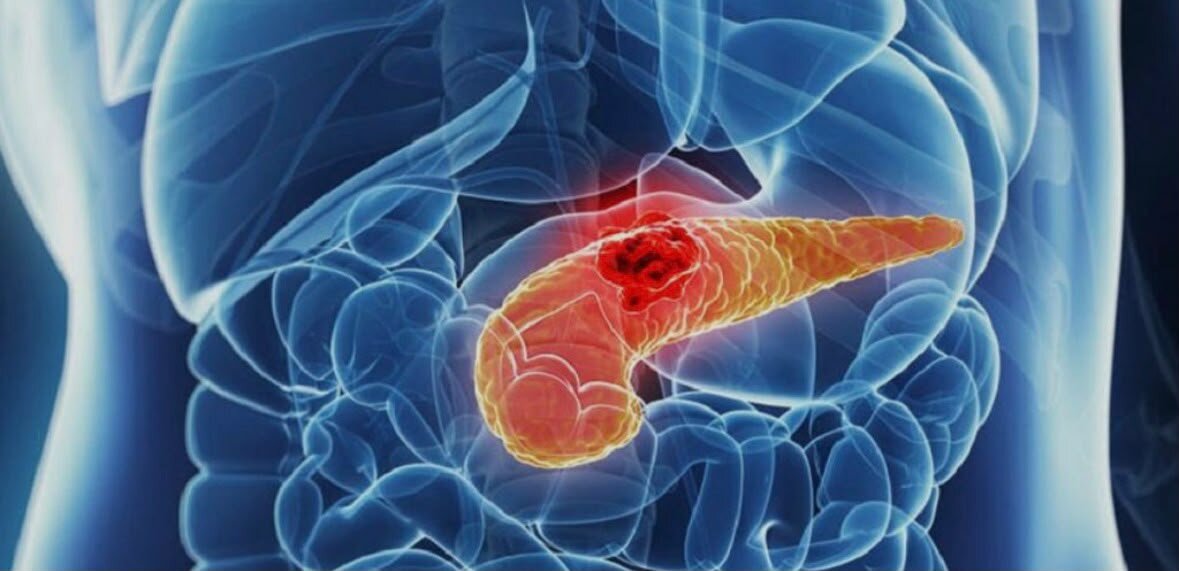 Su SudSalute Tumore al pancreas: identificata la proteina che rende inefficaci le cure