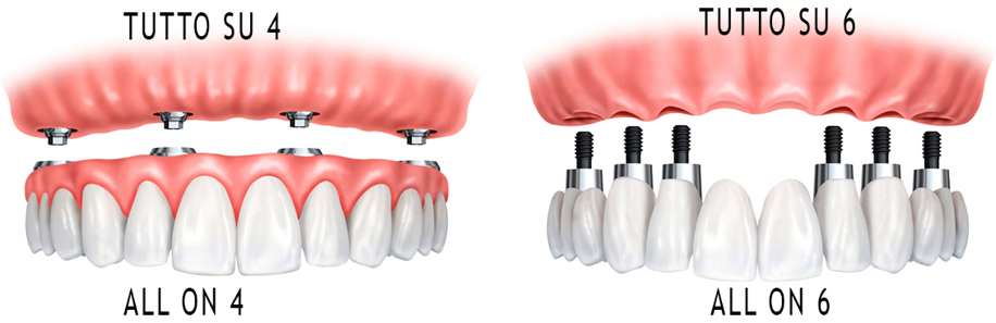 Quanto Costa Un Impianto Dentale In Albania