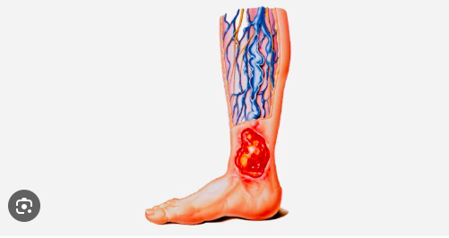 Ulcere del piede diabetico: l&rsquo;ozonoterapia come supporto alla guarigione