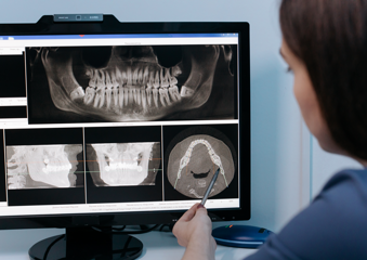 Impianti dentali computer guidati a Tolmezzo