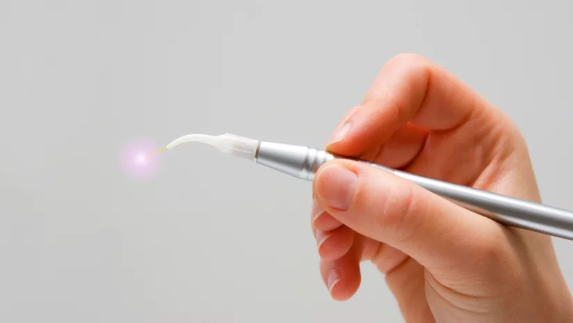 Laser dentale a Trieste e Mantenimento parodontale e controlli gengivali periodici a Trieste Laser dentale a Trieste e Mantenimento parodontale e controlli gengivali periodici a Trieste