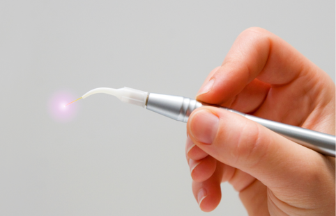 Laser dentale per la cura della parodontite presso Polodent Udine
